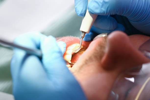 Best Emergency Root Canal Treatment in Claypool Hill, VA